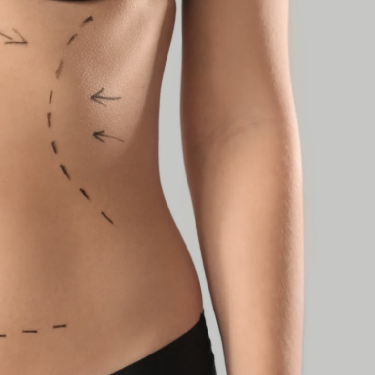 Free Liposuction Assessments for Body Contouring Near Arlington